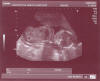 Eco_2007-05-24_18semanas_4.jpg (40979 bytes)